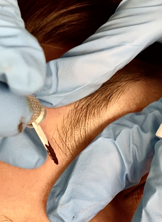 Close-up of a person's armpit being shaved with a razor, surrounded by blue medical gloves.